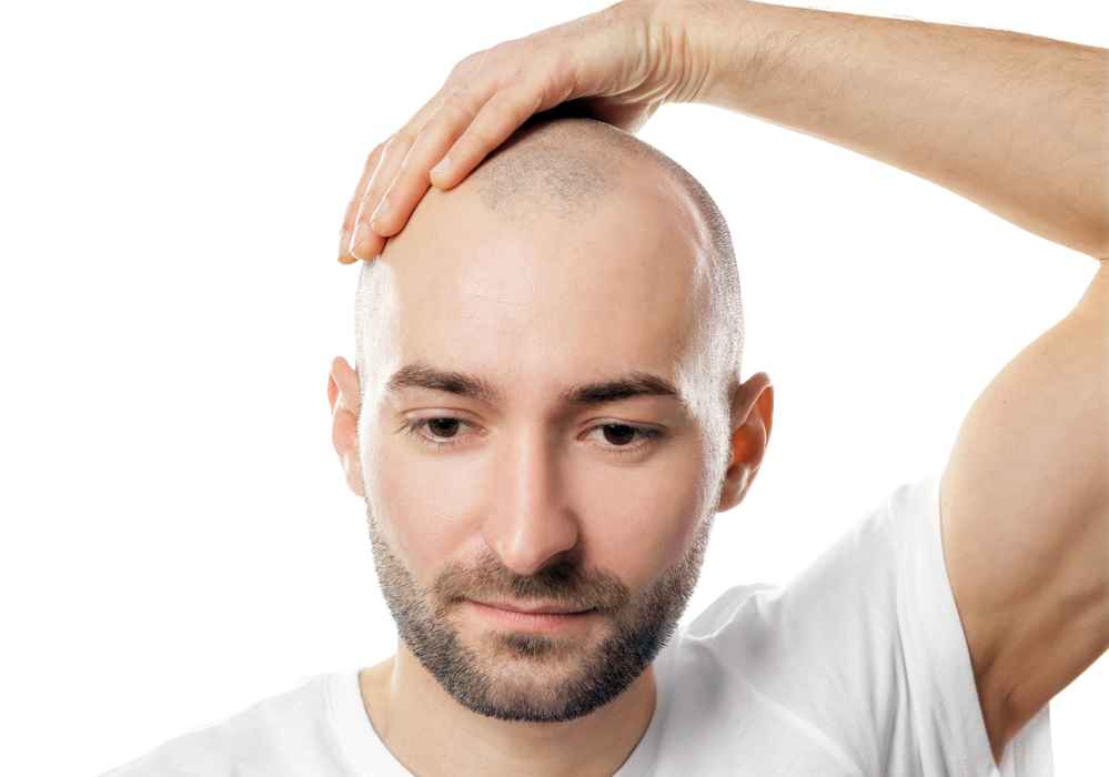 Can Hair Grow Back After Balding