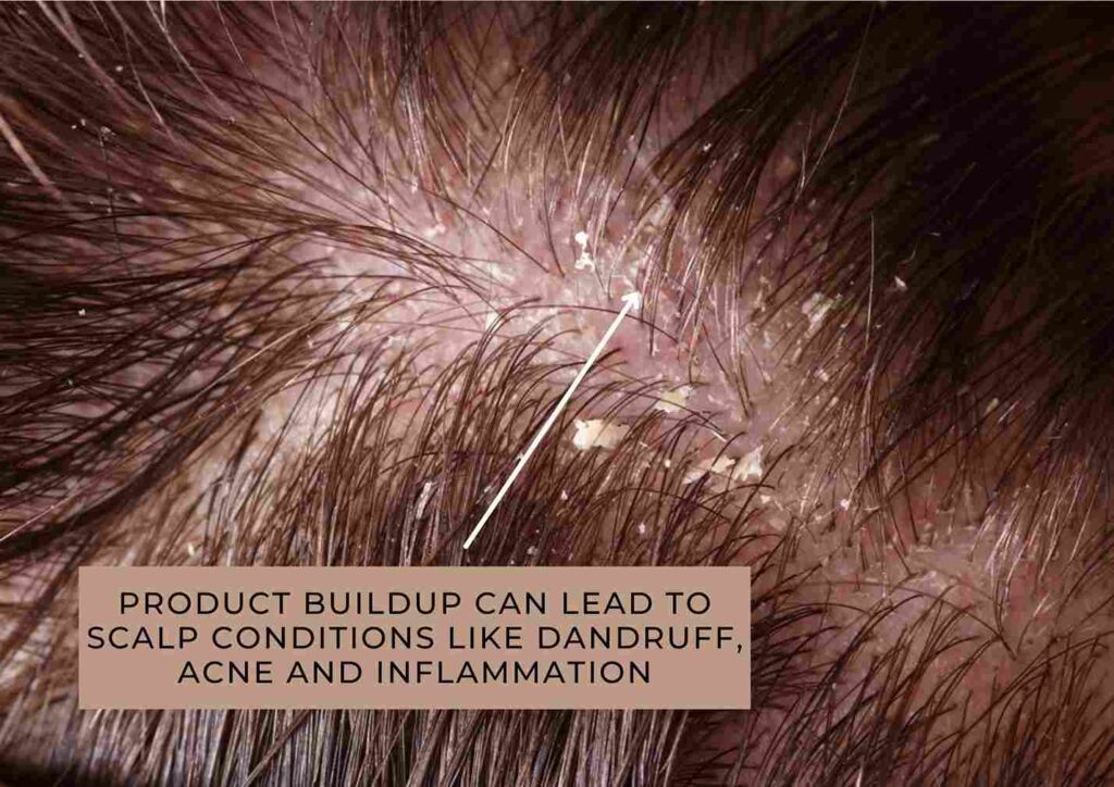 product build up in hair vs dandruff