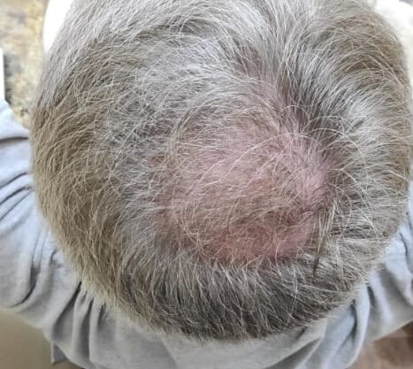 actiiv for male pattern baldness 