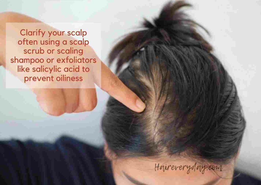 home remedies for oily scalp and dandruff