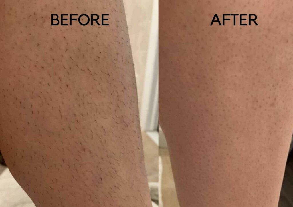10 Best Hair Removal Creams in the Philippines 2023 | Buying Guide Reviewed  by Dermatologist | mybest