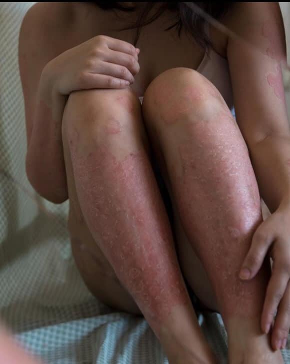 what is psoriasis