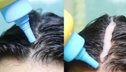 korean scalp treatment