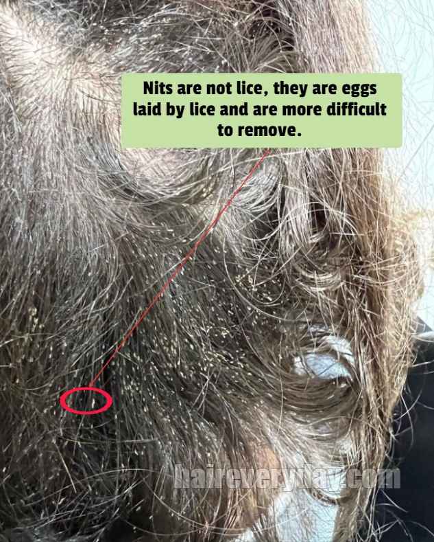 9 Home Remedies For How To Get Rid of Head Lice | Be Beautiful India