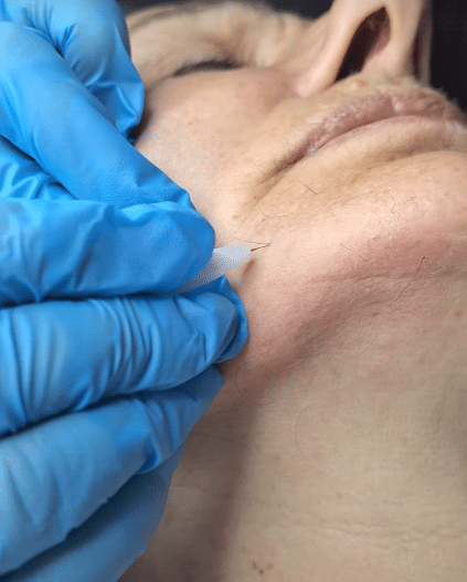 What Is Electrolysis Hair Removal And How Is It Done